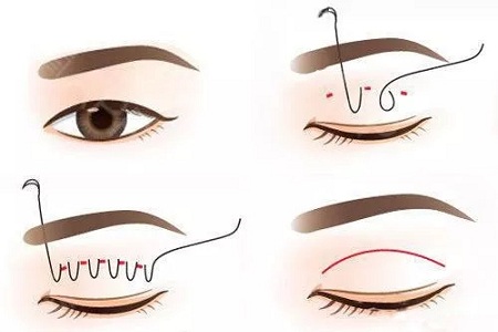 三點定位重瞼術(shù)