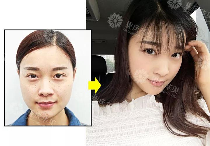 都是用激光打，祛雀斑、黃褐斑、老年斑有啥區(qū)別？