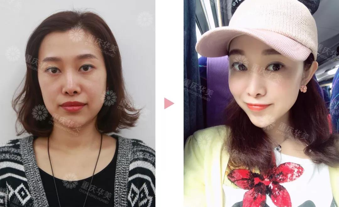 提升做了一年后，臉會不會比以前垮？