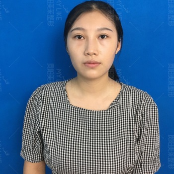 美萊案例宋青青對(duì)比圖后