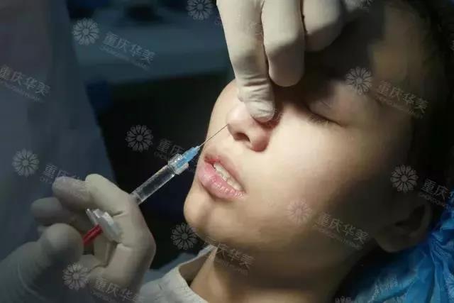 同樣是打玻尿酸，注意這幾點讓效果更持久