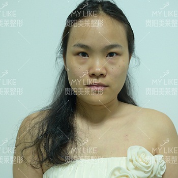 美萊案例蘇沐然對(duì)比圖后