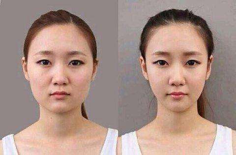 成都華美做臉部抽脂一般多少錢(qián)