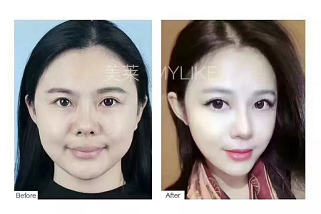 想抗衰，*雕和玻尿酸哪個更適合？