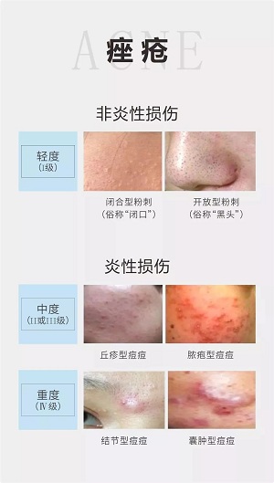 痤瘡分為粉刺和毛囊炎兩大類，按輕重程度分成四個(gè)等級(jí)