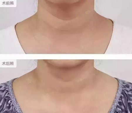 平復頸紋，延緩衰老