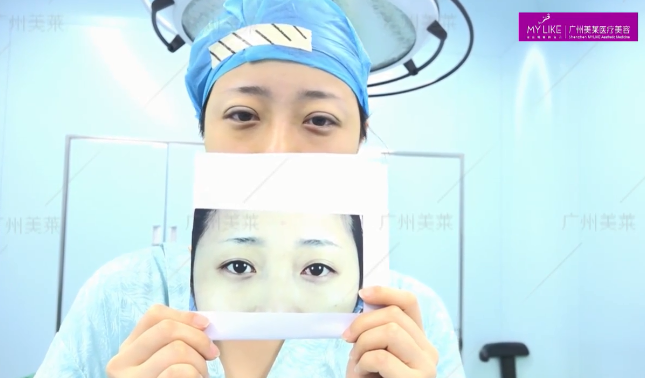 廣州美萊眼綜合，真人對(duì)比效果