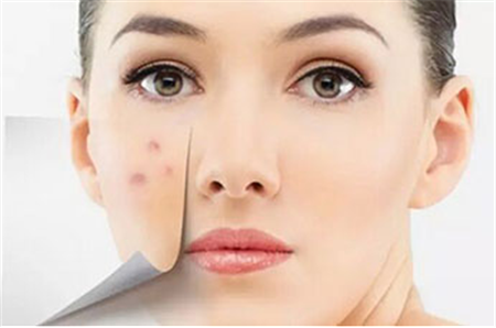 激光治療痘印多少錢(qián)