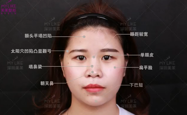 深圳美萊眼神全面改善，整體效果才能大大加分！