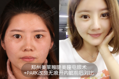 雙眼皮全切好還是埋線好？鄭州美萊割雙眼皮哪位醫(yī)生好？