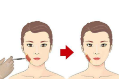 鄭州美萊整形瘦臉針注射效果好嗎？
