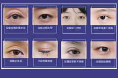 鄭州美萊雙眼皮修復(fù)為什么比割雙眼皮貴？