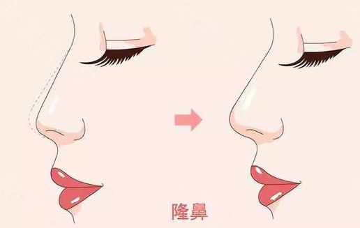 <a href='/zz/' target='_blank'><u>鄭州美萊</u></a>整形醫(yī)院隆鼻有幾種、效果怎么樣？