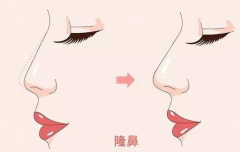 鄭州美萊整形醫(yī)院隆鼻有幾種、效果怎么樣？