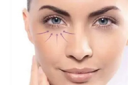 激光去眼袋術(shù)后恢復要多長時間