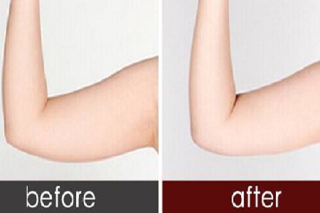 貴陽(yáng)手臂吸脂需要多少錢