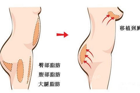 曲靖自體脂肪豐胸維持多久？有哪些優(yōu)點(diǎn)