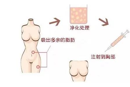 曲靖自體脂肪豐胸維持多久？有哪些優(yōu)點(diǎn)