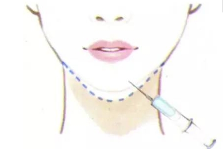 福州自體脂肪維持多久？美萊讓你的脂肪不再迷失方向