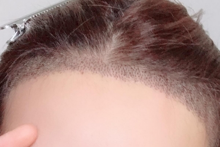 常州發(fā)際線調(diào)整效果好嗎，發(fā)際線如何調(diào)整？