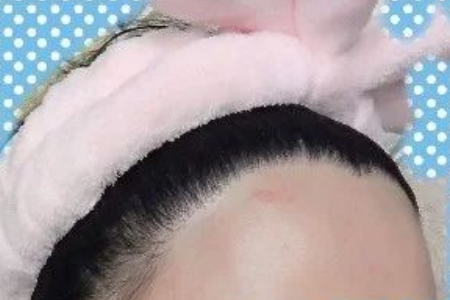 常州發(fā)際線調(diào)整效果好嗎，發(fā)際線如何調(diào)整？