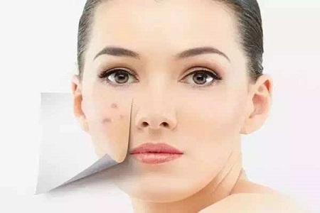 長沙激光祛痘印價(jià)位