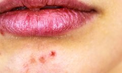 廣州哪家醫(yī)院做激光去痘痘手術(shù)好，激光祛痘大概需要多少錢