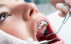 學(xué)生箍牙齒一般多少錢，2023牙齒矯正價(jià)格表