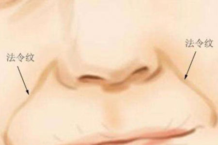 去法令紋手術需要多少錢