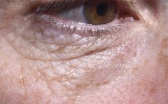 淚溝型眼袋怎么去除，成都、重慶、鄭州價(jià)格參考表