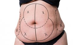 腰部抽脂減肥安全嗎，蘇州、南京、杭州費(fèi)用表