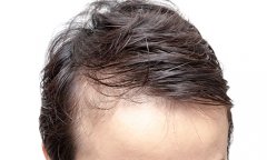 重慶萬州地區(qū)發(fā)際線種植醫(yī)院哪家好，植發(fā)術后要注意什么