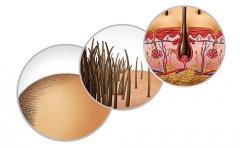 植發(fā)手術(shù)可以改善禿頂嗎，植發(fā)多少錢