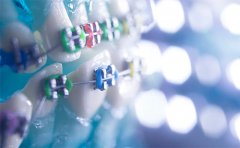 自鎖托槽牙齒矯正多少錢，石家莊、西安、泉州價格一覽表