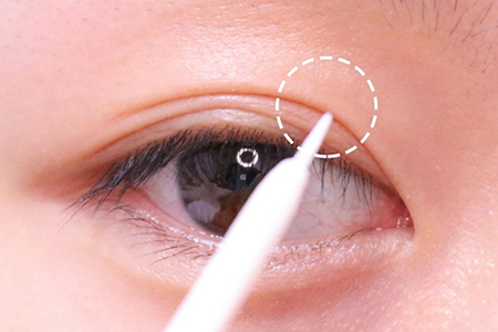 廣州做雙眼皮整形手術(shù)要多少錢，會(huì)不會(huì)很貴