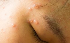 激光去痘印一般要幾次才能好，術(shù)后怎么護(hù)理