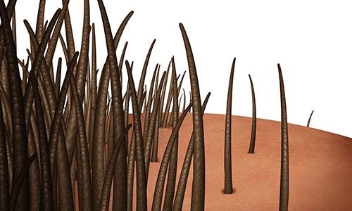 重慶頭發(fā)種植醫(yī)院哪家好一點，植發(fā)手術后多久恢復正常