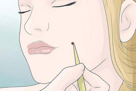 酒窩整形術(shù)后注意事項(xiàng)