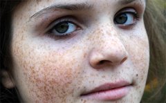 激光祛雀斑怎么樣，原理、優(yōu)點介紹，2023價格參考