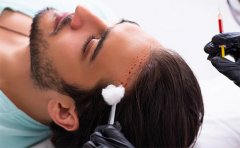 哪家整形醫(yī)院植發(fā)效果比較好，排名前三美萊、紫馨、華美資料分享