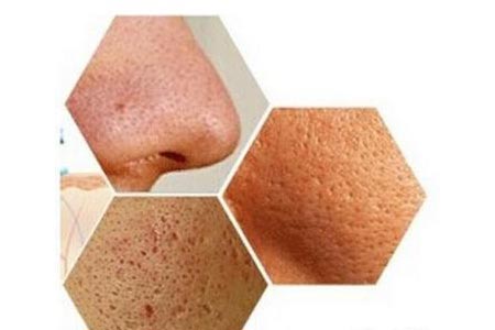 激光收縮毛孔大概多少錢，貴不貴啊