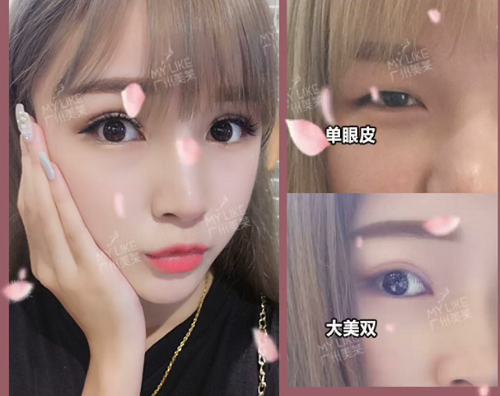 廣州美萊9大雙眼皮模板，你pick哪款？