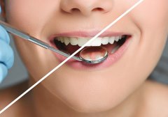 福州做冷光美白牙齒價(jià)格多少錢，一次可以維持多久