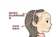 種植發(fā)際線哪家醫(yī)院口碑好，植發(fā)需要多少錢