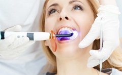 冷光美白牙齒需要做幾次，效果自然嗎，附美白價(jià)格表